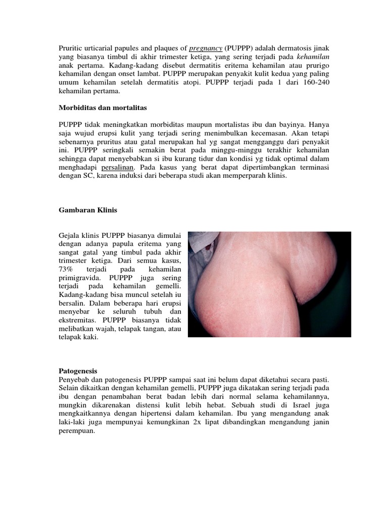 Pruritic Urticarial Papules and Plaques of Pregnancy PDF