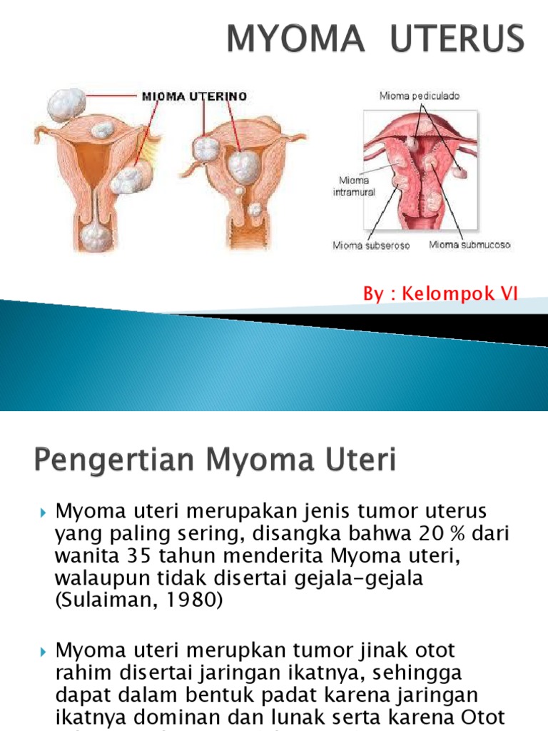 Myoma Uteri: Gejala dan Terapi | PDF | Sains & Matematika