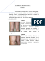 Insuficiencia Venosa Crónica