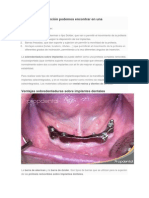 Tipos de retención en sobredentaduras