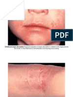 The Mouth. in This Child There Is Lichenification and Fissuring and Crusting