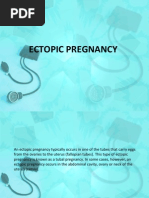 ECTOPIC PREGNANCY.ppt