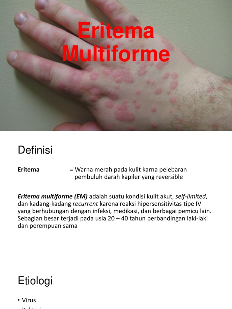 Eritema Multiforme PDF