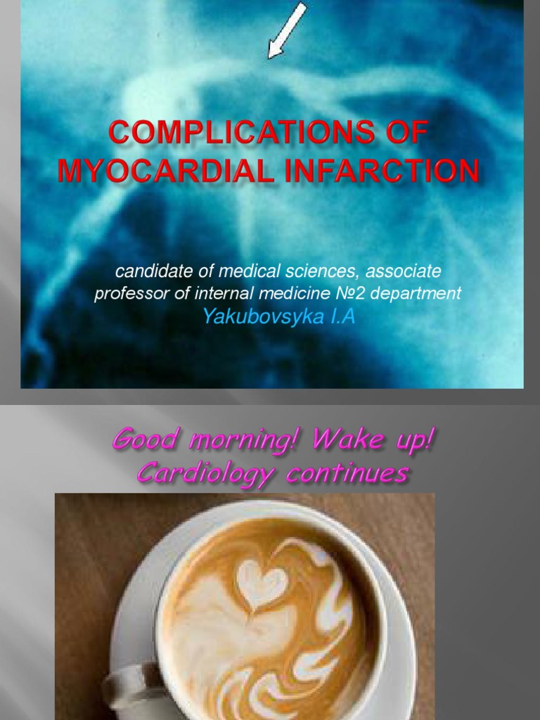 Myocardial Infarction Complications Overview | PDF | Myocardial ...