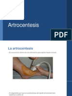 Artrosentesis