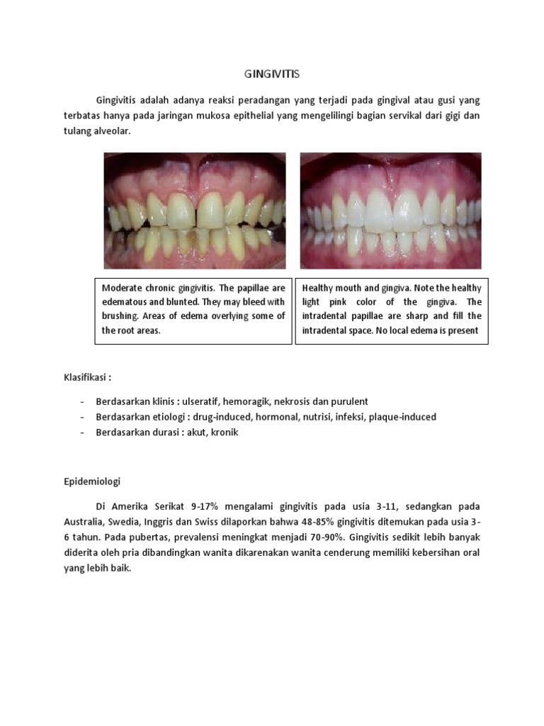 Gingivitis | PDF