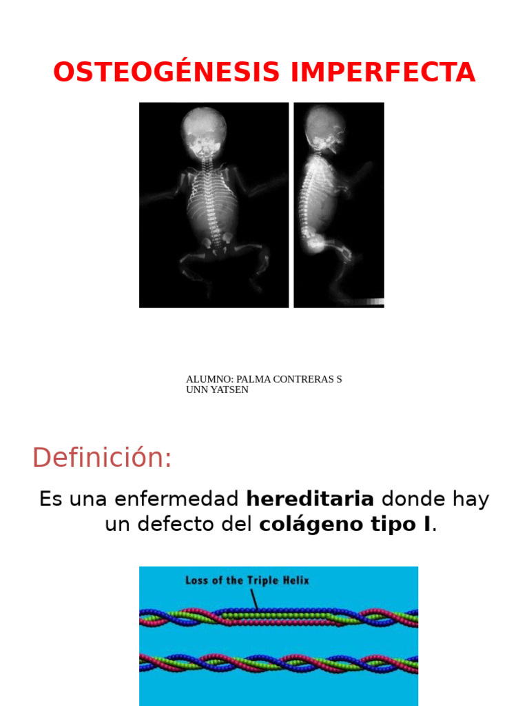 osteogenesis-imperfecta-pdf-hueso-trastorno-gen-tico