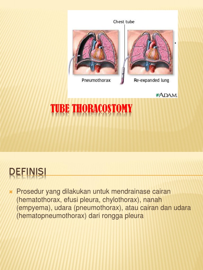 Chest Tube Thoracostomy