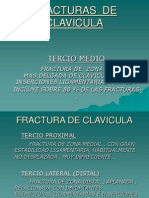 Fracturas de Clavicula