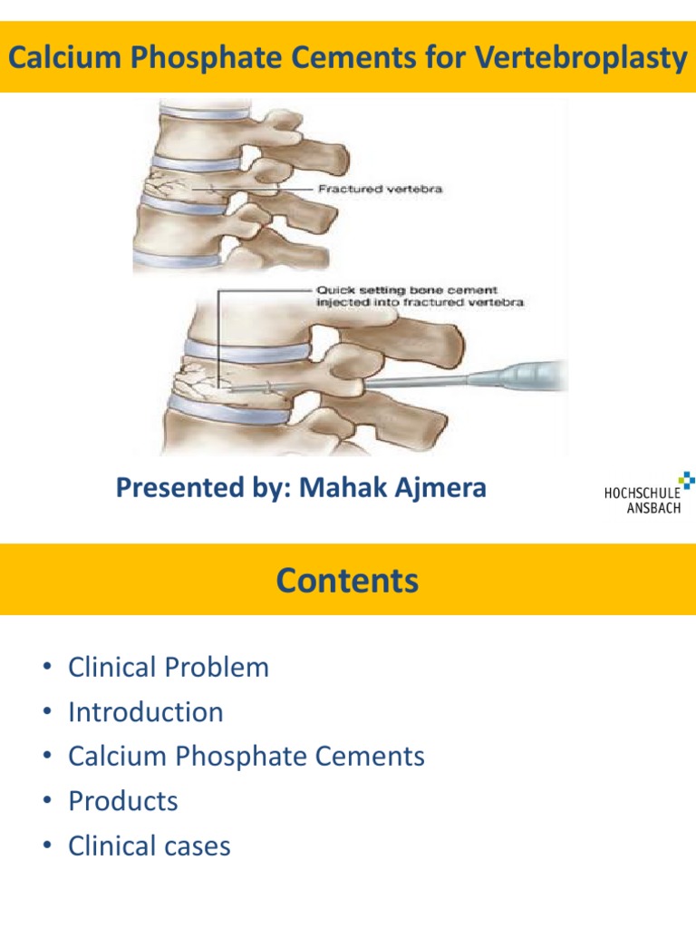 Vertebroplasty: Calcium Phosphate Cements | PDF | Medical Specialties ...