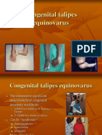Congenital Talipes Equinovarus
