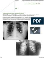 Pneumomediastino e Asma - DR - Pierre D'almeida Telles Filho