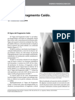 Signo del Fragmento Caído Radiología