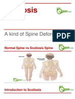 Scoliosis: A Kind of Spine Deformity