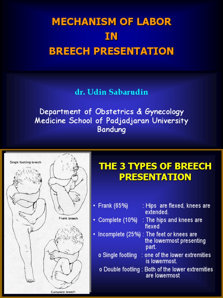 breech presentation mechanism of labour