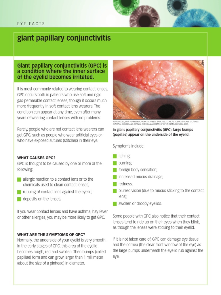 Giant Papillary Conjunctivitis AAO PDF Contact Lens Allergy