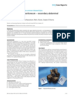 An Unusual Haemoperitoneum - Secondary Abdominal Pregnancy