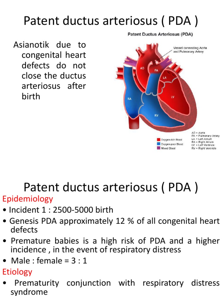 Patent Ductus Arteriosus ( PDA )