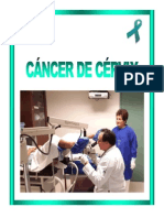 Cancer Cervix 14