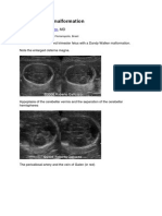 Dandy Walker Malformation: Roberto Noya Galluzzo