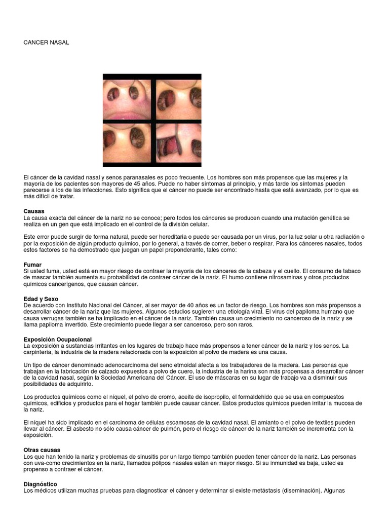 Cancer Nasal | PDF | Ct Scan | Cáncer