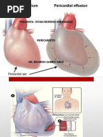 Pericarditis 