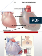 Pericarditis 