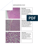 ADENOKARSINOMA COLON.doc