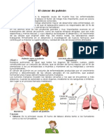 El cáncer de pulmón