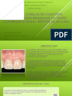 El Uso de Carillas de Composite Indirectas Para