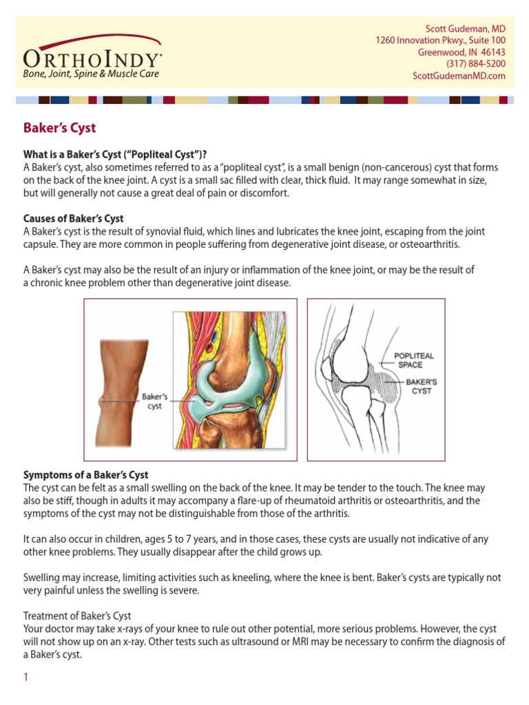 Bakers Cyst Osteoarthritis Knee
