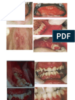 Stomatitis Herpetika Primer , HFMD