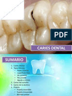 Caries dental: tipos, causas y tratamiento
