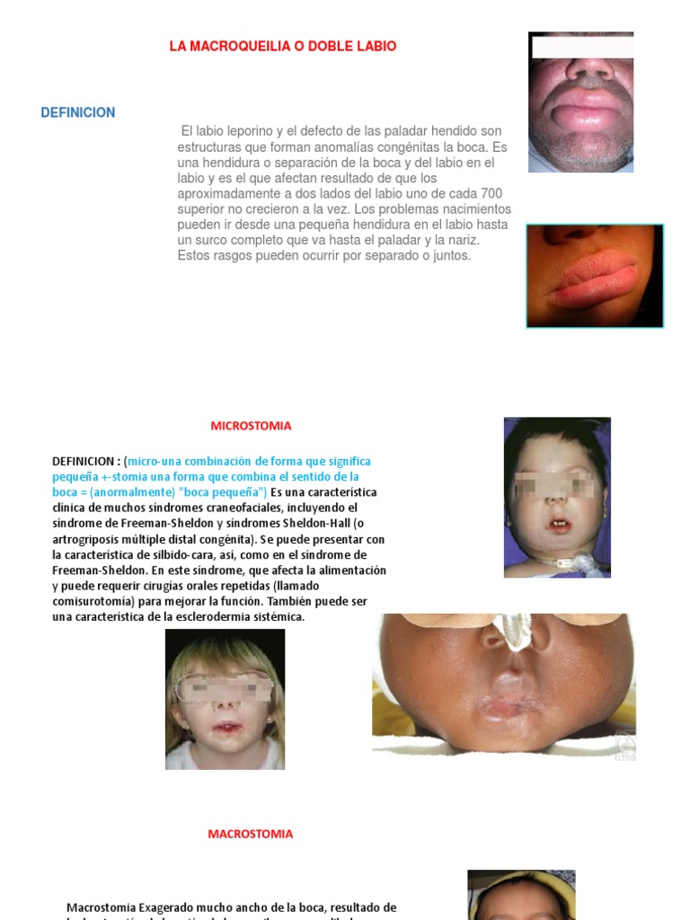 Definición de Macroqueilia y Microstomía | PDF | Boca | Medicina CLINICA