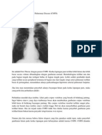 Chronic Obstructive Pulmonary Disease