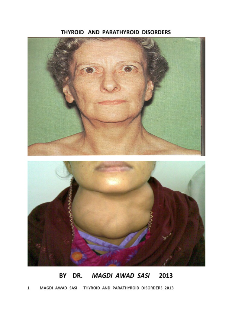 Thyroid and Parathyroid Disorders Guide | PDF | Hyperthyroidism ...