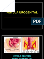 Fistula Urogenital