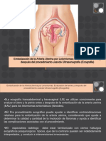 Embolizacion de La Arteria Uterina Para Leiomiomas