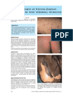 Management of Stevens-Johnson Syndrome and Toxic Epidermal Necrolysis