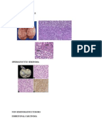 Seminomatous Tumors Seminoma