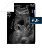 Atresia Duodenal