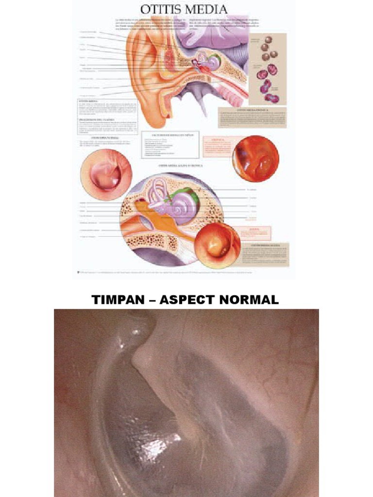 Otite | PDF