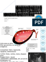 COLECISTITIS AGUDA CALCULOSA