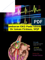 Ekg Aritmia