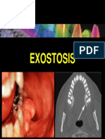 Exostosis 09082