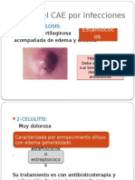 Otitis Externa