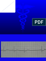 ECG5