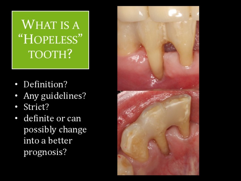 Understanding Hopeless Teeth: Definition & Guidelines | PDF