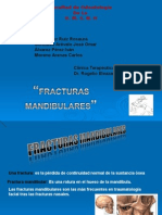 fractura mandibular