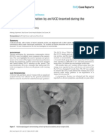 Silent Uterine Perforation by An IUCD Inserted After The Puerperium